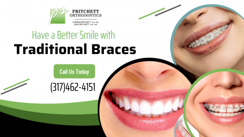 Do you want to straighten your smile with traditional braces? At Pritchett Orthodontics, we offer orthodontic treatment that can shift crooked teeth, fix gaps and correct overbites, underbites and cross bites problems. Contact us today at (317)462-4151!