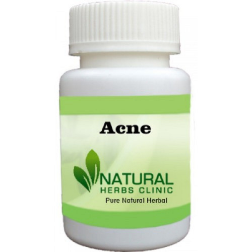 Herbal Treatment for Acne read the Symptoms and Causes. Acne is a common skin condition that develops when the hair follicles in your skin are blocked by dead skin and oil... https://www.naturalherbsclinic.com/product/acne/