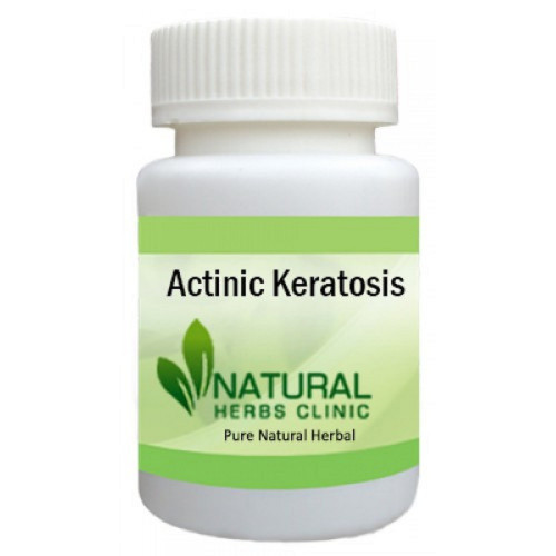 Herbal Treatment for Actinic Keratosis read the Symptoms and Causes. Actinic Keratosis is a scaly spot found on sun damaged skin... https://www.naturalherbsclinic.com/product/actinic-keratosis/