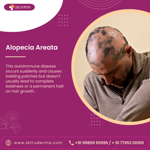 Alopecia-Areata-Hair-loss-Treatment-In-Sarjapur-Road.png