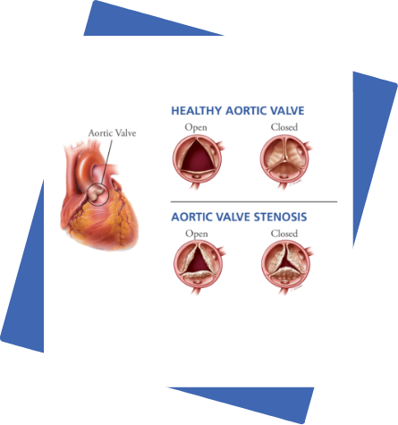 Aortic-valve-stenosis.png