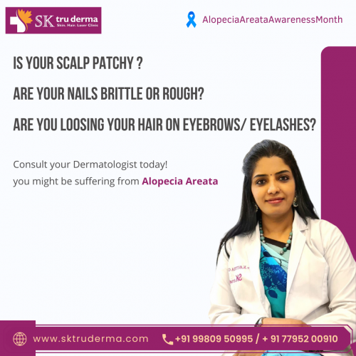 Are you suffering from Alopecia, Consult Best Dermatologist in Sarjapur Road