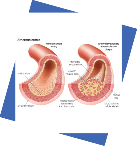 Atherosclerosis.png