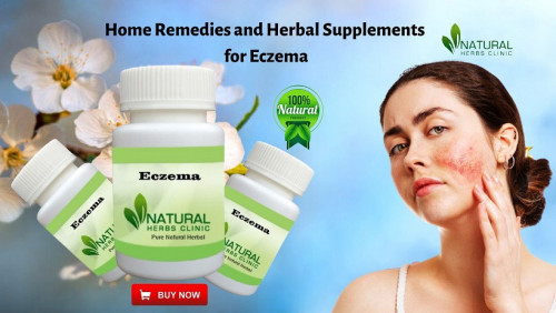 Eczema-Herbal-Supplements-and-Remedies-Supportive-Option-to-Treat-It.jpg