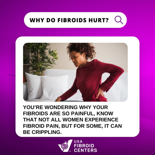 Fibroid pain depends on the location, size and number of tumors in the uterus. Women with small fibroids may experience no pain, while those with larger fibroids may feel severe pain. Find out more about fibroid pain