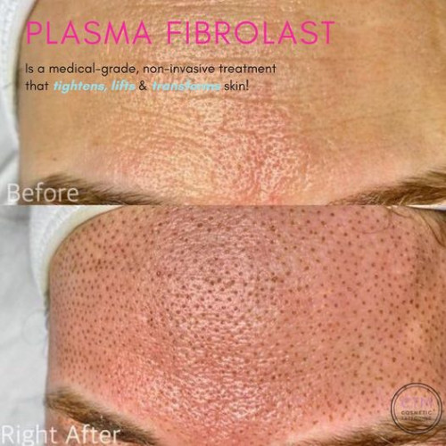 One of our favourite treatments with amazing results! Plasma is a revolutionary, medical-grade treatment. This innovative plasma fibroblast treatment revitalises and returns a more youthful look to your face, neck, body and hands. Our highly trained therapists here at Cosmetic Tattooing Melbourne are ready to treat you with this state-of-the-art cosmetic procedure – why not book today? Visit: https://cosmetictattooingmelbourne.com.au/plasma-fibroblast-therapy/

#plasmafibroblastmelbourne #plasmafibroblasttreatment #cosmetictattooing #CosmeticTattooingMelbourne