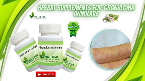 Herbal Supplements For Granuloma Annulare can help to treat the skin disease by reducing its causes and symptoms. https://www.naturalherbsclinic.com/product/granuloma-annulare/