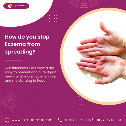 How do you stop Eczema from spreading, Best Dermatologist in Sarjapur Road