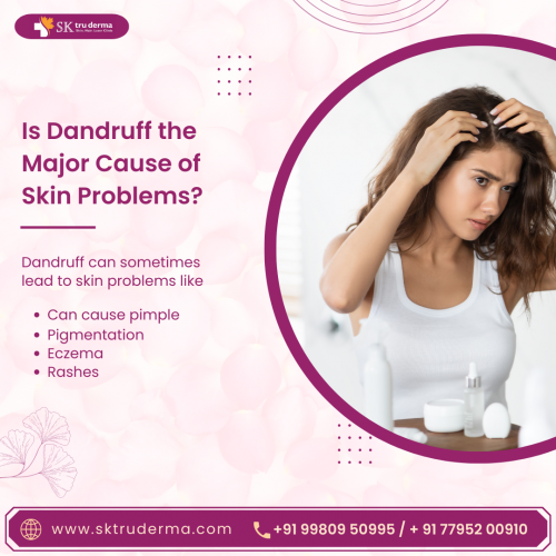 Is-Dandruff-the-cause-of-skin-problems-Best-Skin-Care-Centre-in-Sarjapur-Road.png