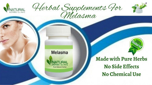 Although complicated, melasma can still be removed. And as we already mentioned, you can treat your melasma at home with a few natural home remedies and Herbal Supplements for Melasma without any side effects. https://www.naturalherbsclinic.com/blog/melasma-herbal-supplements-cure-skin-disease-in-easy-ways-now/