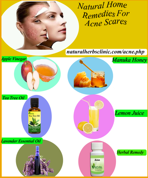 Lemon juice can be highly effective for Natural Remedies for Acne spots, as long as it’s only applied to wounds or zits that haven’t been picked or popped... http://naturalherbsclinic.hatenablog.com/entry/natural-remedies-for-acne