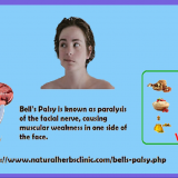 Natural-Remedies-for-Bells-palsy