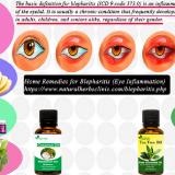 Natural-Remedies-for-Blepharitis