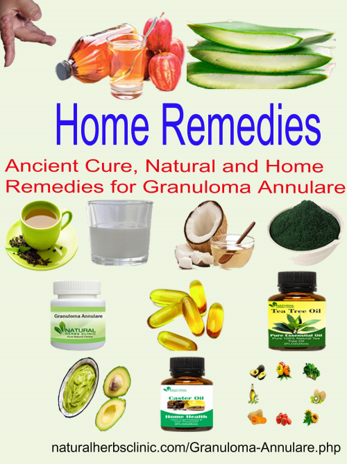 Natural-Remedies-for-Granuloma-Annulare.png