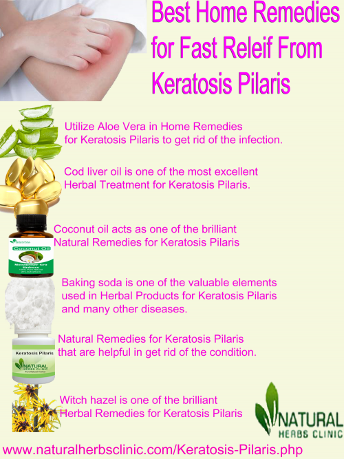 Coconut oil acts as one of the brilliant Natural Remedies for Keratosis Pilaris, and it is excellent not just for your hair but for your skin also. Its sole fatty acids make softer the skin and supply nourishment from within... https://www.naturalherbsclinic.com/blog/natural-remedies-for-keratosis-pilaris/