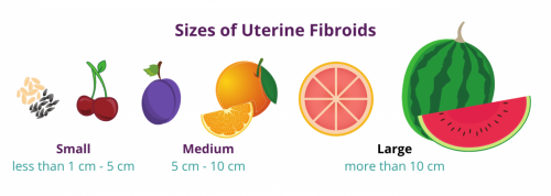 fibroid tumor sizes, and how they can determine what kinds of symptoms occur. Although uterine fibroids are a common medical condition, many women don’t understand what fibroids are and how they can affect their health. To give you a clearer picture, here is a handy guide to uterine fibroids, complete with a fibroid tumor size chart, a symptom checklist, and treatment options. https://www.usafibroidcenters.com/blog/visual-guide-uterine-fibroids/