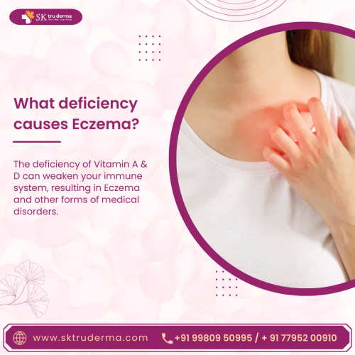 What deficiency causes Eczema, Best Dermatologist in Sarjapur Road