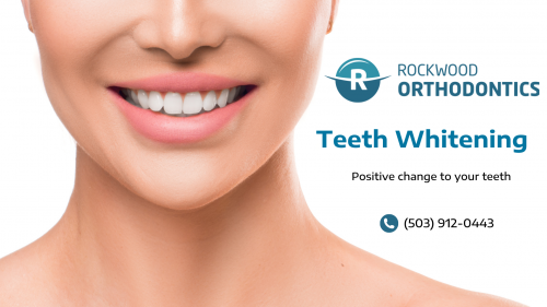 We got an in-house team of experienced specialists delivering top-notch teeth whitening for patients with the appropriate use of leading-edge technologies. Schedule an appointment today at info@rockwoodsmiles.com.