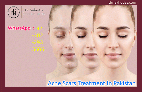 acne scars treatment in pakistan