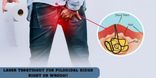 So, opting for laser treatment for pilonidal sinus near me is far much better than the traditional treatments.
https://laser360clinic.com/is-it-right-to-have-laser-treatment-for-pilonidal-sinus/