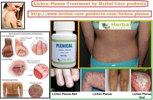 lichen planus treatment by natural herbal remedies