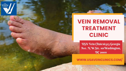 vein-removal-treatment-clinic-1.png